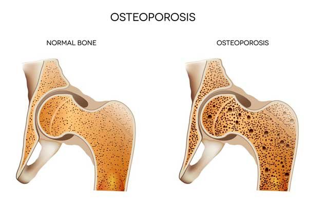 What is osteoporosis and how can we avoid it.